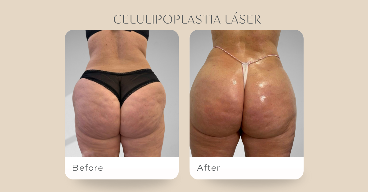 Celuliploplastia