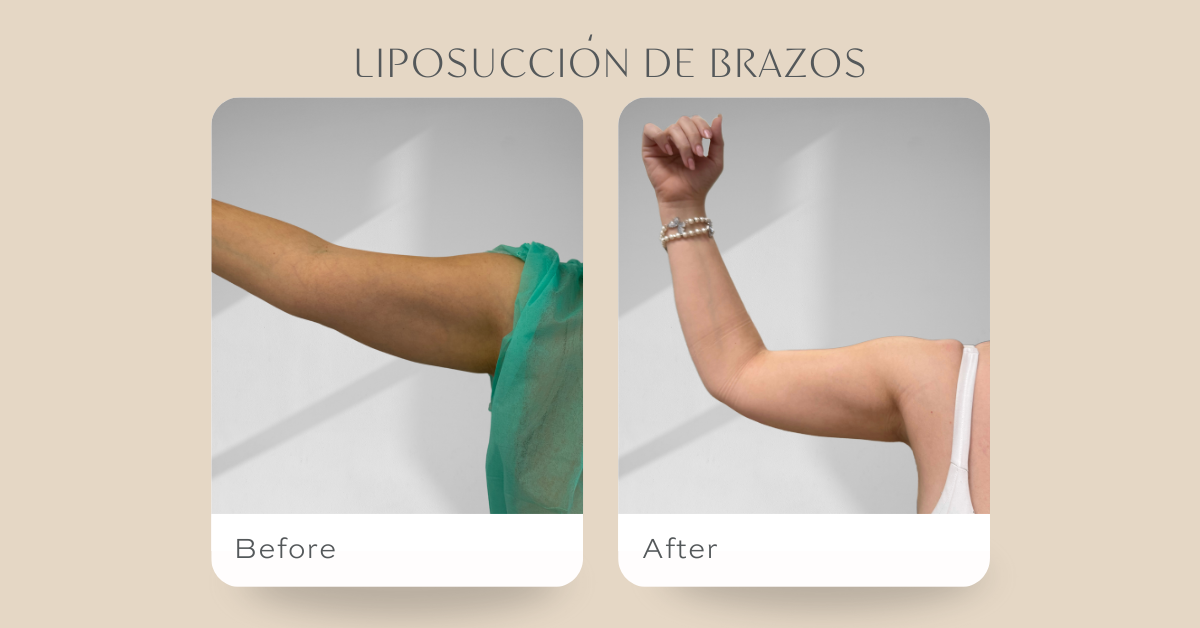 Lipo B-Endolixt