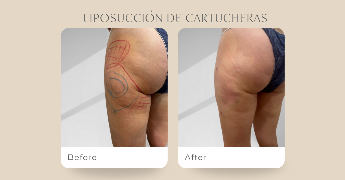Lipo K-Cartucheras